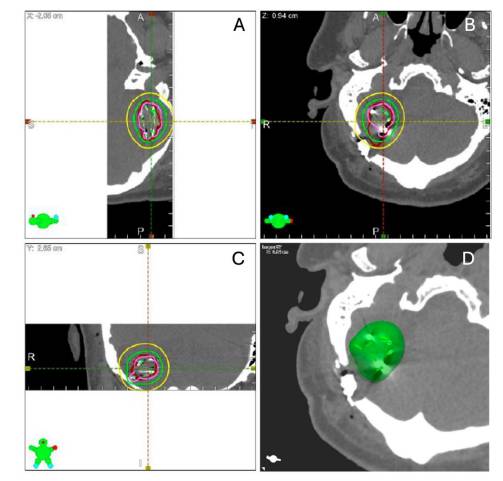 JNeurooncol's tweet image. Mahapatra et al. @Tulane evaluated minimally invasive keyhole craniotomy combined with Cs-131 brachytherapy for brain oligometastases, demonstrating excellent local control (91.7% at 1 year) with minimal toxicity and preserved function. #JNO
Read more:link.springer.com/article/10.100…