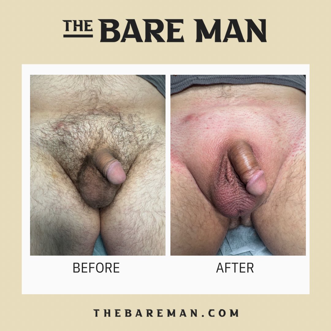 First time client in for a full manzilian! Amazing results and handled it like a champ! #thebareman #manzilian #brozilian #wax #waxing #malewaxing #westchester