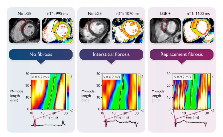 EHJCVIEiC's tweet image. Ultrasound shear wave elastography for detection of myocardial #fibrosis by Dr Petrescu and colleagues ➡️ academic.oup.com/ehjcimaging/ad… @ESC_Journals @escardio @EACVIPresident @bernhard_gerber @EZancanaroMD @pabloplopez_ @BenekiEirini @AnnaKateBarton @OttoSmiseth