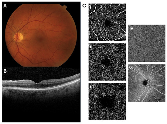 NMOphthalmology's tweet image. 🚨 PUBLICATION ALERT 🚨
Retinal Imaging as a Window into Cardiovascular Health: Towards Harnessing Retinal Analytics for Precision Cardiovascular Medicine
Authors included: Rukhsana Mirza, MD (@rg_mirza)
Article Link: mdpi.com/2308-3425/12/6…