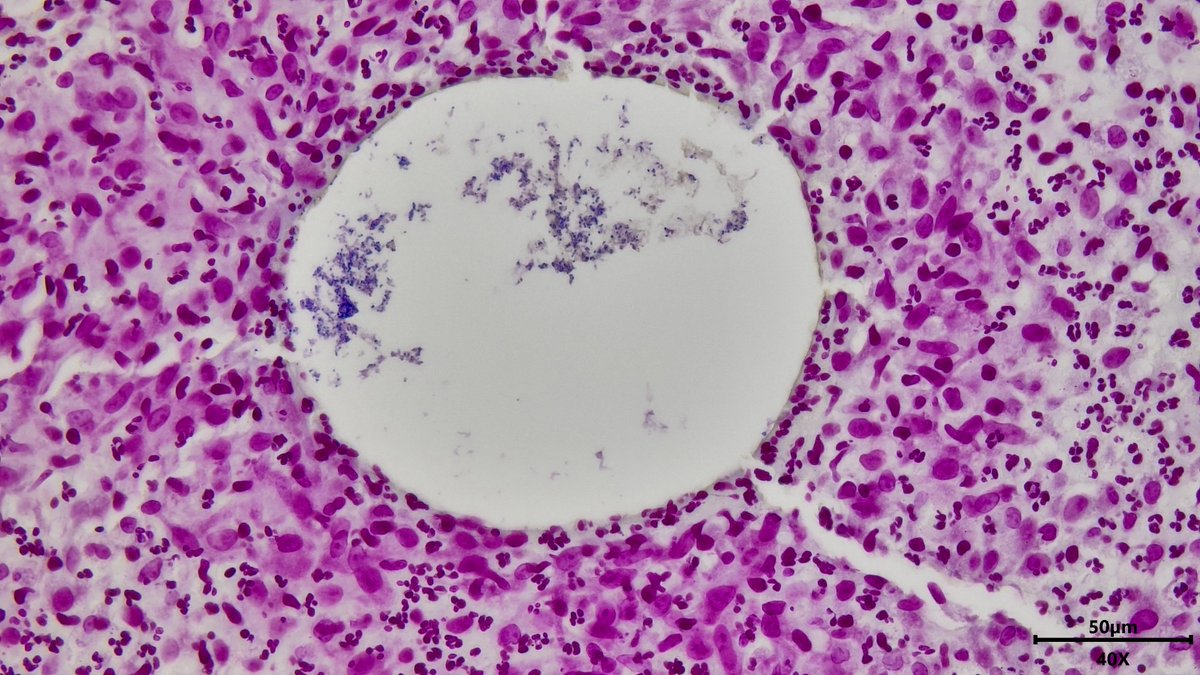 This has been posted many times before but it is just such a perfect example! Who knows what it is? Breast core needle biopsy #breastpath #pathology #pathresidents #pathx #pathtwitter #pathbugs