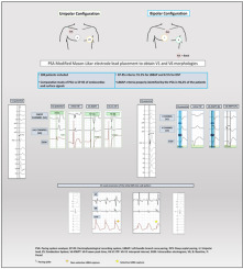 Pacing System Analyzers to guide Conduction System Pacing implantation procedures: A comparison study of intracardiac and surface signals with an Electrophysiological Recording System

heartrhythmjournal.com/article/S1547-…