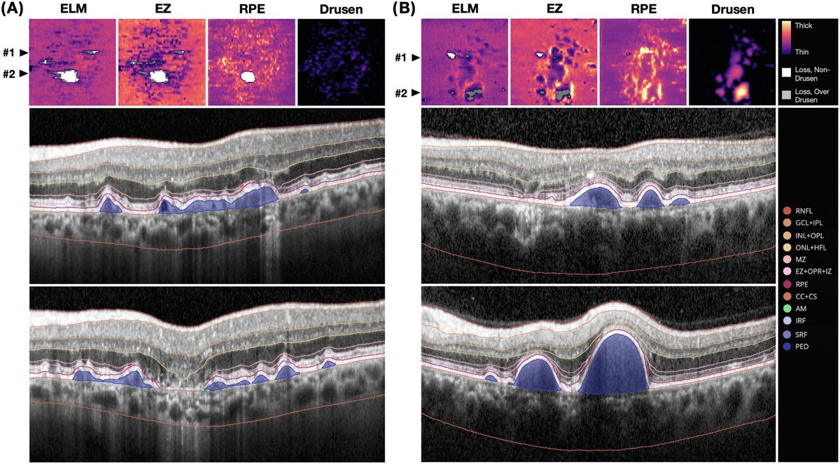 Effect of Subthreshold Nanosecond Laser on Loss of OCT Outer Retinal Bands in Age-Related Macular Degeneration: A LEAD Study Report
ow.ly/pqOB50W4IS3
#ophthalmology