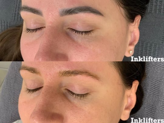 Whether your microbladed brows have taken on a mind of their own, the pigment has faded, or it just isn’t your vibe anymore—we can help you hit undo 😎

Just two laser tattoo removal sessions in, and this transformation is already speaking for itself.