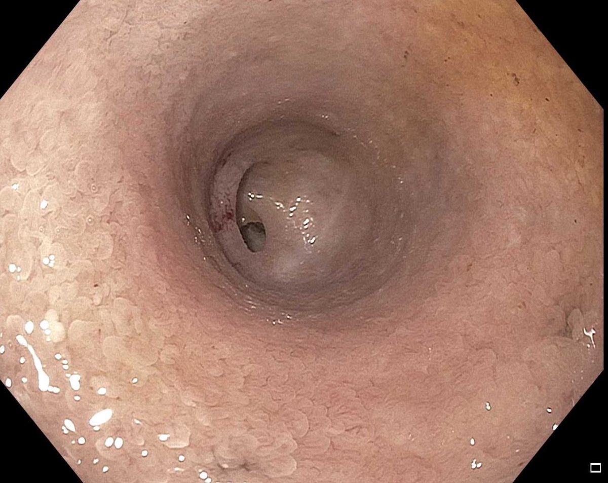 James D. Haddad, MD, FACP (@jameshaddadmd) on Twitter photo When one door closes 🚪, another opens 🛣️
Pancreatic mass obliterating the ampulla 🚫#ERCP
Cystic duct patent -> EUS-GB with resolution of jaundice
#GITwitter #GIX #MedTwitter #MedX #endoscopy #EUS When one door closes 🚪, another opens 🛣️
Pancreatic mass obliterating the ampulla 🚫#ERCP
Cystic duct patent -> EUS-GB with resolution of jaundice
#GITwitter #GIX #MedTwitter #MedX #endoscopy #EUS