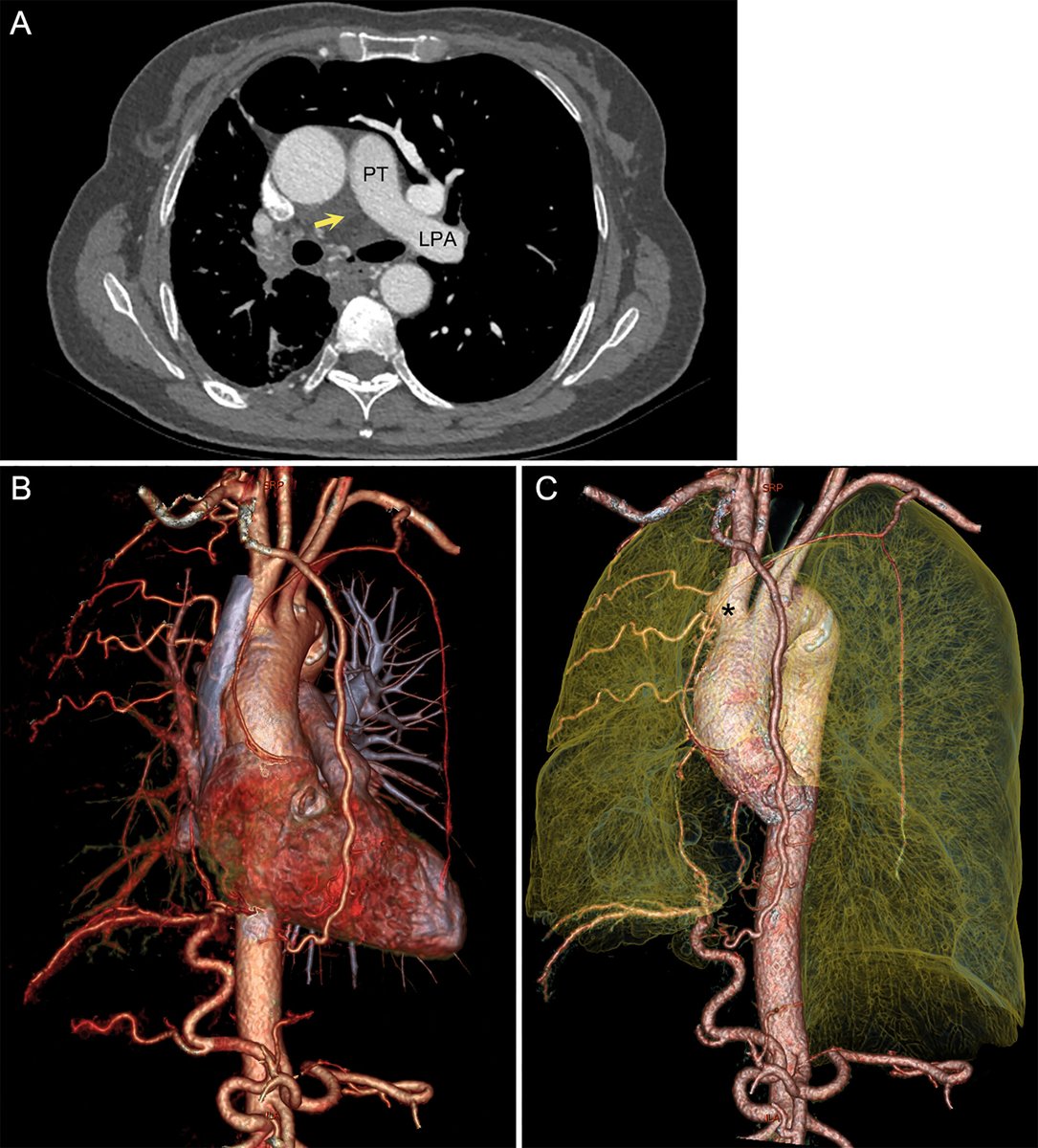 Take a look at a CT angiogram and CT volume rendering depicting absence of a pulmonary artery with extensive collateral circulation in this week's Images in Radiology. bit.ly/4eFNnoB