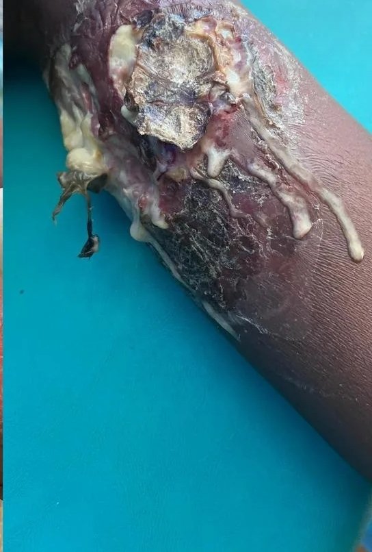 lailama61451664's tweet image. My brother has been missing his hands for about a month. Please help him get treatment. Please support me to buy the treatment. Please. @oliveegirl @MothTongue_ @claude_godin @ainiladra @loukas93749
chuffed.org/project/gaza-b…