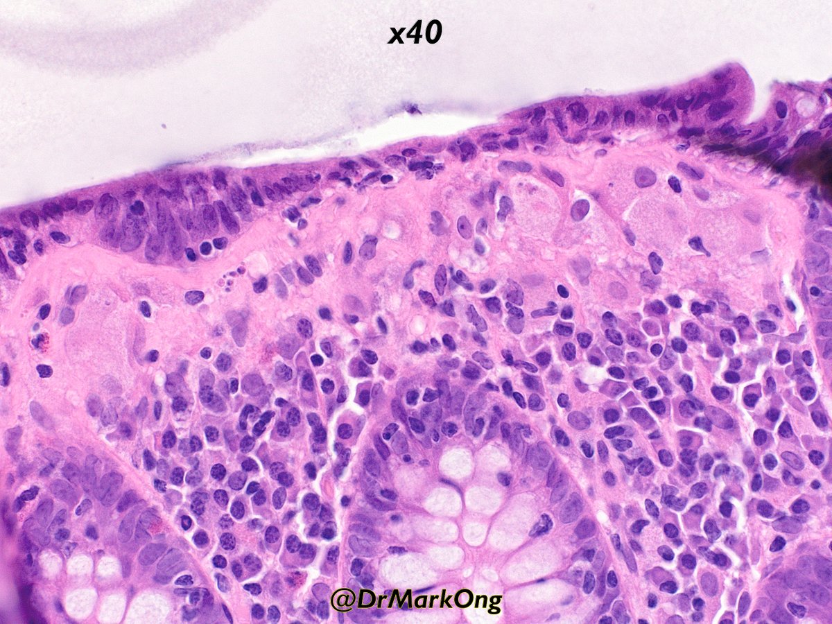 Collagenous colitis with macrophages within the collagen layer.

Seems to behave like standard collagenous colitis:
pubmed.ncbi.nlm.nih.gov/14765272/
pubmed.ncbi.nlm.nih.gov/18985521/

Gratuitous Masson's trichrome &amp; CD68 in next tweet.

#GIpath #pathology #pathX