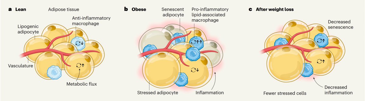 🔬 La pérdida de peso remodela el tejido adiposo más allá de reducir grasa
🔹Un estudio en Nature muestra que, tras cirugía bariátrica, se revierten patrones de senescencia, estrés oxidativo y disfunción mitocondrial en células adiposas.
🔹Sin embargo, persiste una “memoria”