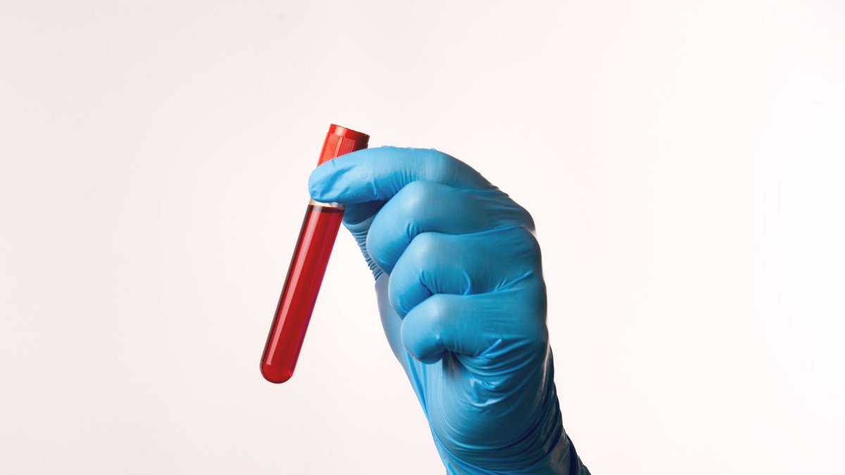 News Medical (@newsmedical) on Twitter photo A landmark UK Biobank study shows how a single blood test can forecast the aging pace of your organs, revealing who’s at greatest risk and opening the door to targeted prevention strategies. news-medical.net/news/20250710/… <a href="/NatureMedicine/">Nature Medicine</a> A landmark UK Biobank study shows how a single blood test can forecast the aging pace of your organs, revealing who’s at greatest risk and opening the door to targeted prevention strategies. news-medical.net/news/20250710/… <a href="/NatureMedicine/">Nature Medicine</a>