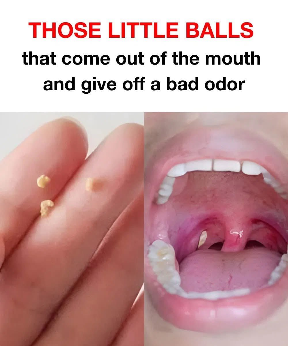 Those small, smelly balls that come out of your mouth?

They’re not “poison,” they’re not spiritual, and they’re not food from last week.

They’re called tonsil stones, and they could be the real reason your breath smells like a gutter — even after brushing.

Let’s break it down