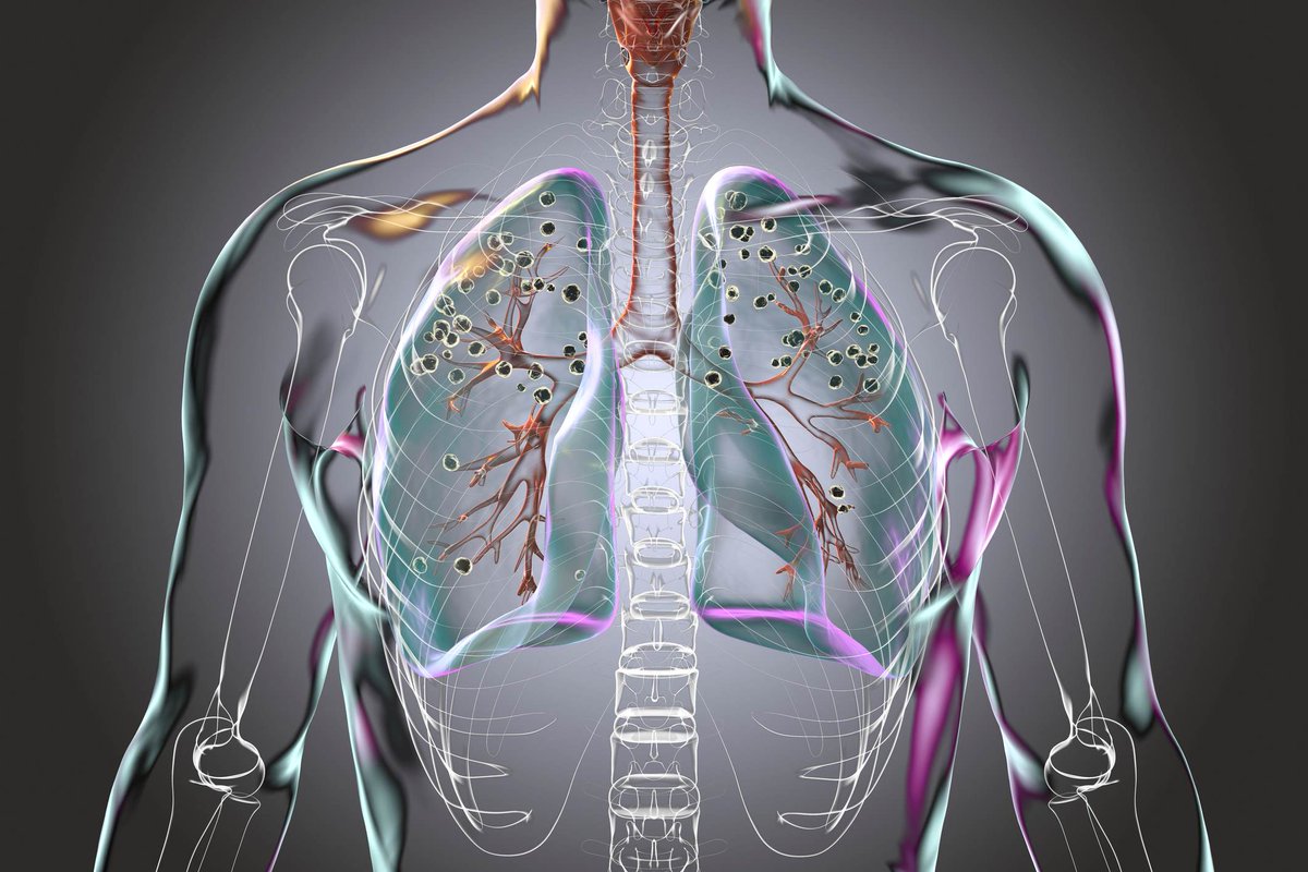 The IMJ (@the_imj) on Twitter photo IMJ July 2025 #FreeAccess
Clinical Perspective: Management of pulmonary fibrosis
bit.ly/3IkW7EO
<a href="/TheRACP/">The Royal Australasian College of Physicians</a> <a href="/WileyHealth/">Wiley Clinical Health</a>
Pulmonary fibrosis is a progressive, high-morbidity disease. New research is expanding treatment beyond IPF to other fibrotic ILDs. IMJ July 2025 #FreeAccess
Clinical Perspective: Management of pulmonary fibrosis
bit.ly/3IkW7EO
<a href="/TheRACP/">The Royal Australasian College of Physicians</a> <a href="/WileyHealth/">Wiley Clinical Health</a>
Pulmonary fibrosis is a progressive, high-morbidity disease. New research is expanding treatment beyond IPF to other fibrotic ILDs.