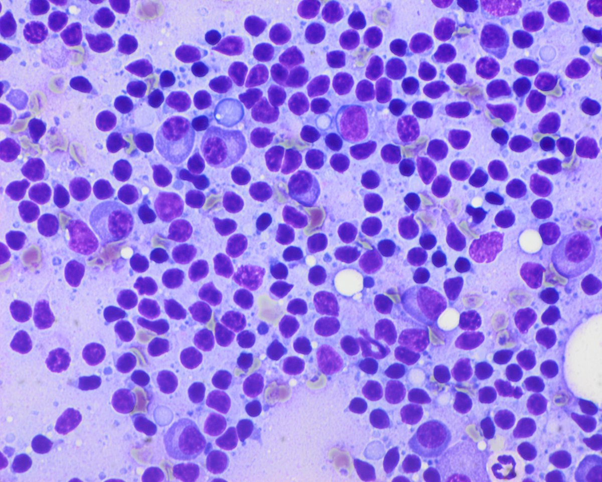 Pepe Jiménez Heffernan (@pepeheffernan) on Twitter photo CC369. 70/F. Painful FNA of a subcutaneous lesion on the ventral aspect of the left wrist. It is a fusiform lesion that is in the tendon plane. Radiologists suggest a tendon or neural tumor. The patient has an interesting history, and a scar on the contralateral wrist <a href="/kriyer68/">Kalyani Bambal</a> CC369. 70/F. Painful FNA of a subcutaneous lesion on the ventral aspect of the left wrist. It is a fusiform lesion that is in the tendon plane. Radiologists suggest a tendon or neural tumor. The patient has an interesting history, and a scar on the contralateral wrist <a href="/kriyer68/">Kalyani Bambal</a>