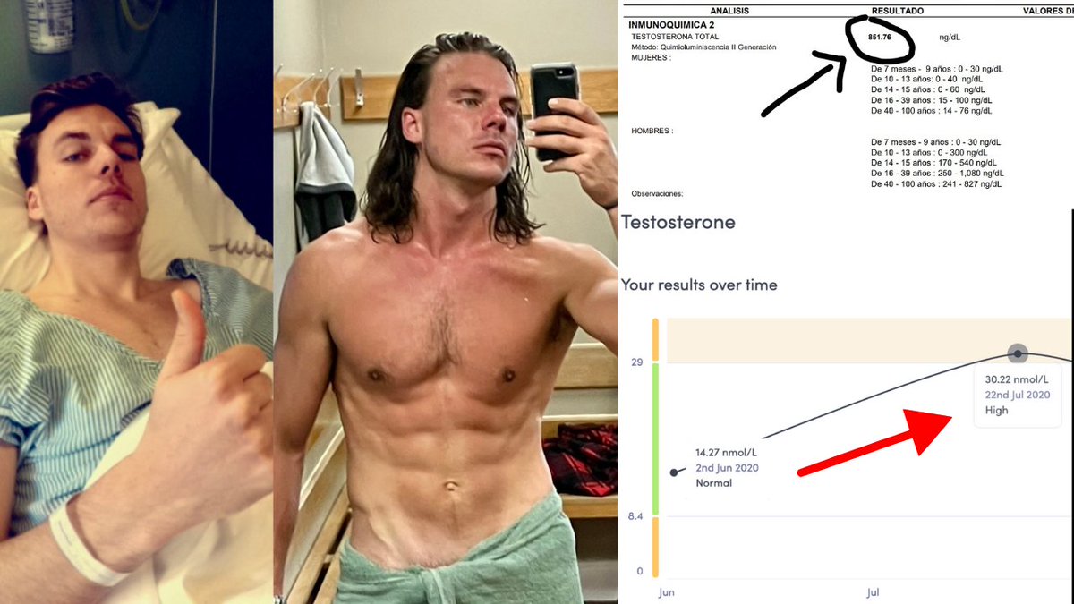 yoursimmo's tweet image. Doctors told me I’d never recover my testosterone after cancer.
Today, my testosterone sits at 851 ng/dL without TRT.
That’s double what most men your age are walking around with.
Here’s exactly how I did it and how you can too:🧵