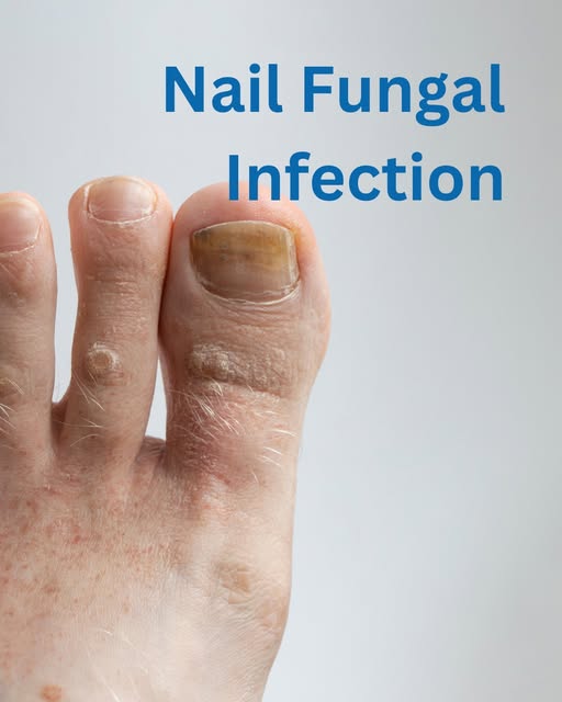 GillianAMichael's tweet photo. Do you have a nail fungal infection?
We can offer a treatment plan to get you back on your feet.
#nailfungus #nailhealth #nailcare #nails #infectednails #podiatrist #londonpodiatrist https://t.co/y6i8UkeZ5o