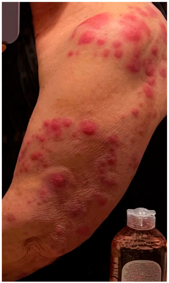 📢Erythema Nodosum Leprosum in a Patient with Borderline Lepromatous Leprosy: A Case Report mdpi.com/3398886 #mdpiidr via <a href="/MDPIOpenAccess/">MDPI</a> #infected #infectionfreezone #disease #medicine #hospital #bacteria #virus #pathology