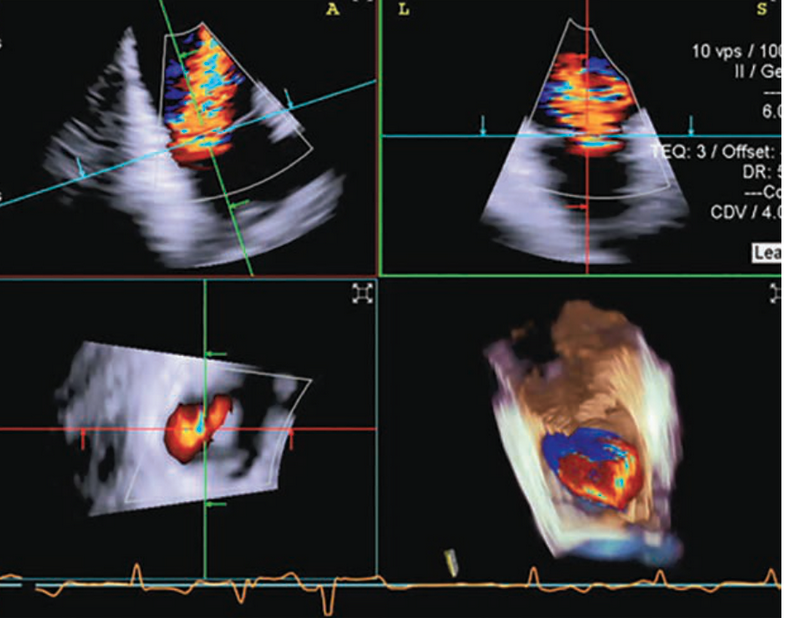 CathLabDigest's tweet image. Advancing tricuspid valve repair: 4D intracardiac echocardiography (ICE) offers enhanced imaging during TEER procedures. A case from Erasmus MC showcases its potential in improving outcomes.
hubs.ly/Q03wLGq20 #cardiotwitter @invasivecardiol