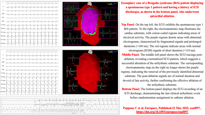 drraviele's tweet image. 📌 High-risk #BrugadaSyndrome random. trial
👉 Epicardial #ablation + ICD assoc. w/ ⬇️ in VF recurrence compared w/ #ICD alone
#EPeeps #suddendeath #ECG #CardioTwitter #MedTwitter @DrRoderickTung @Dr_Santangeli @DoctorPhillEP @drluissaenz @ftrae @SeguraCardio @LluisMont2 @Hragy