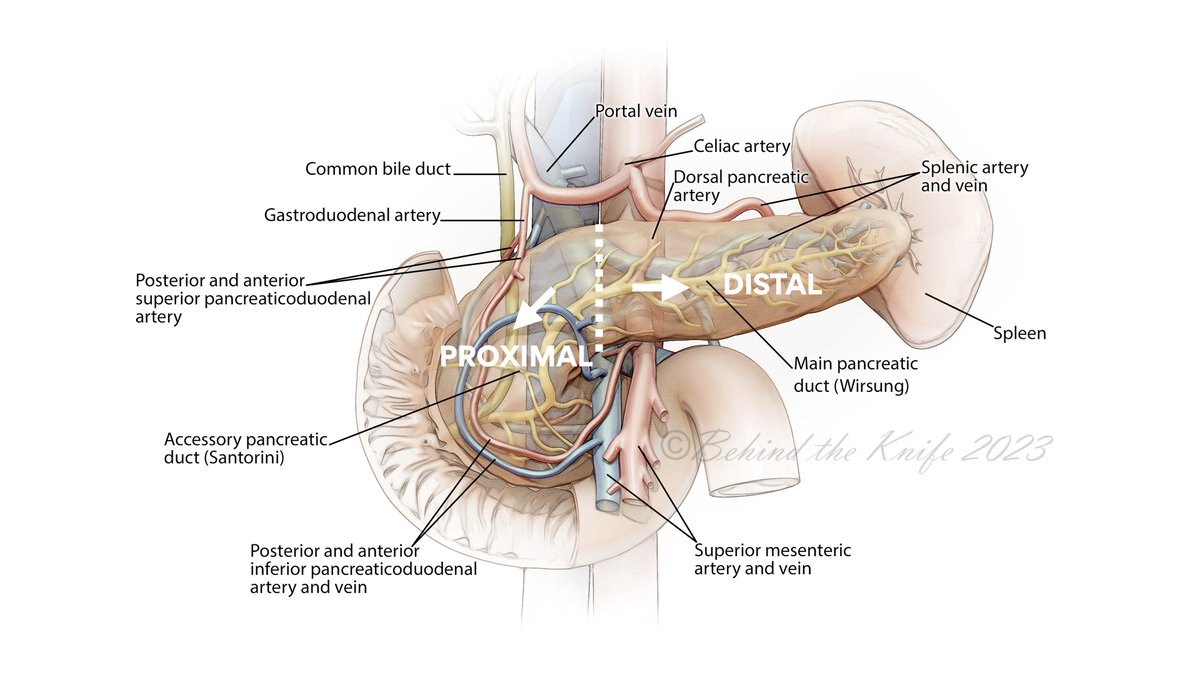 As the surgical maxim goes, don’t mess with the pancreas!

But if you do, some general considerations:

✔️ Drain, drain, drain.
✔️ Consider a staged approach.
✔️ RX determined by location of injury, duct involvement, extent of parenchyma destruction, &amp; patient stability