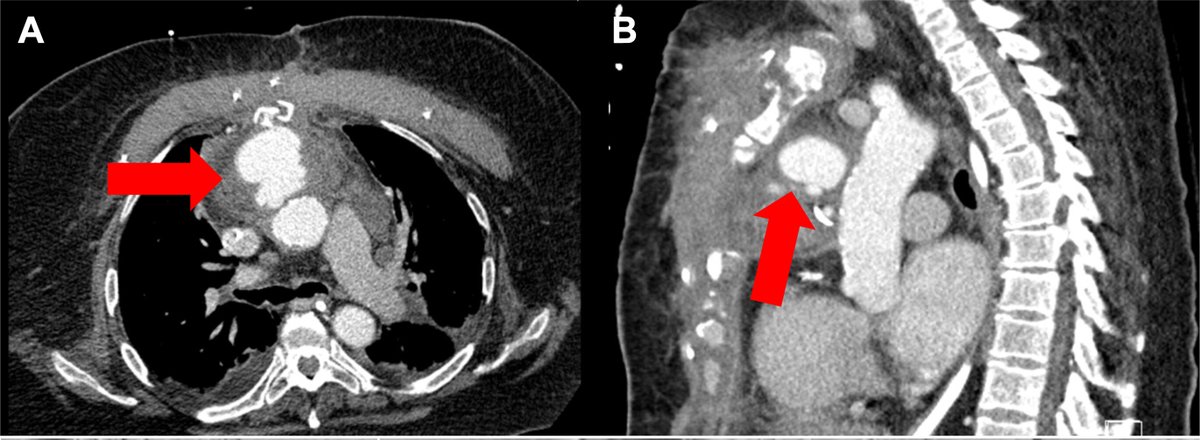 PennCardiology's tweet image. A rare post-CABG complication, aortic pseudoaneurysm, posed high surgical risk for one patient in a recent case by 🩺 @JasonHanMD, @iyengaramit, @rohanshad, @ChaseBrown_MD, et al.
Discover how #endovascularrepair offered a life-saving alternative
➡️ spr.ly/601345Tqd