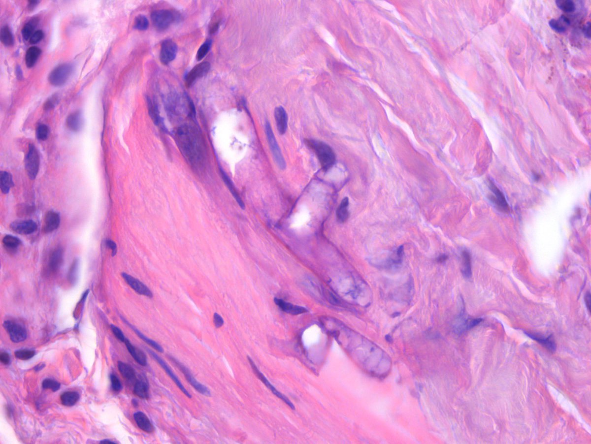 infectotuits's tweet image. Hoy en #FF Fungi Friday
El diagnóstico histopatológico también es importante.
Hifa gruesa, cenocítica, y haciendo un “moño” .
(Biopsia de piel en un paciente trasplantado órgano sólido)
*Mucorales*