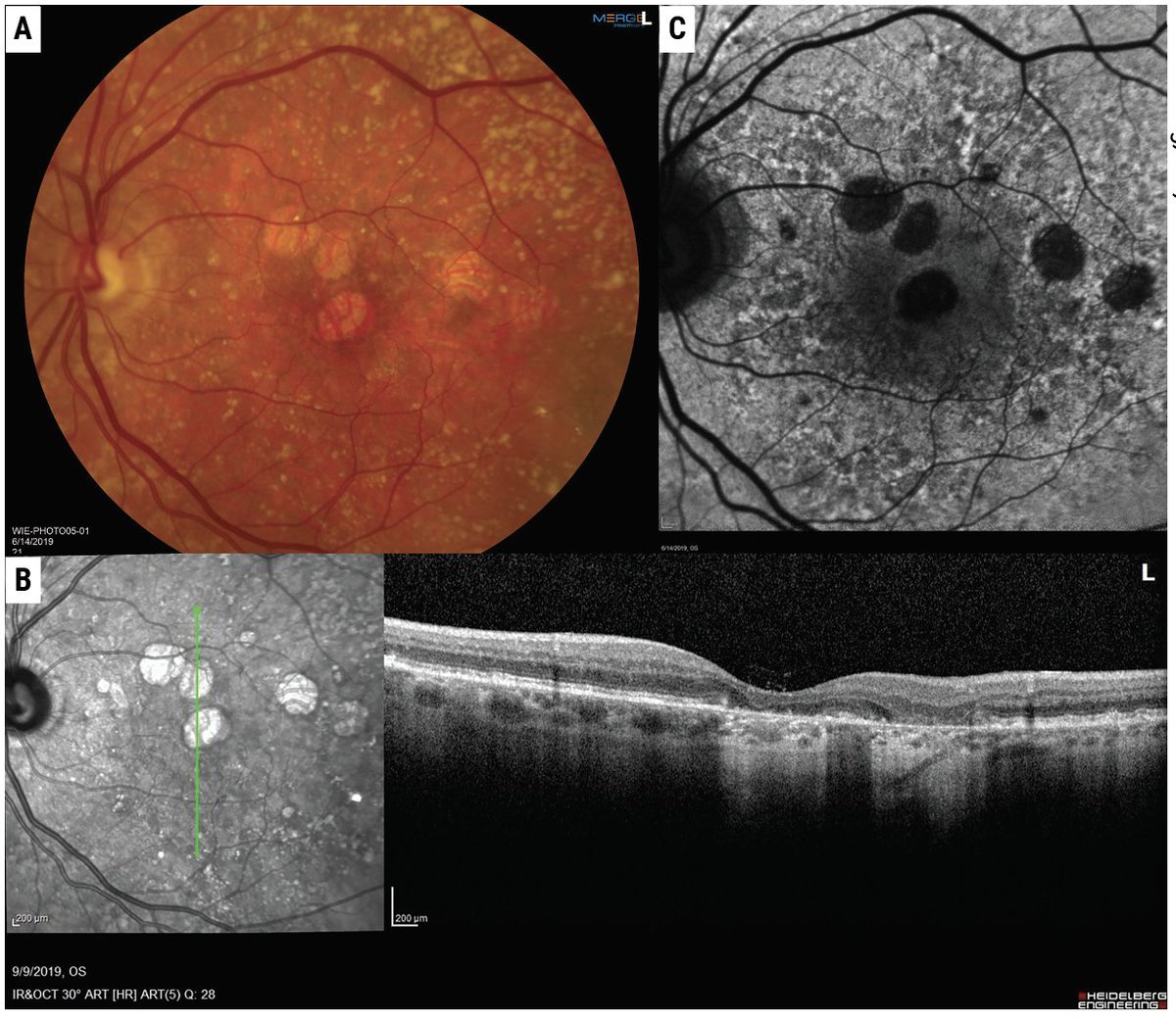 The Pros and Cons of Complement Inhibition

Retina specialists share their thoughts on the advantages and possible shortcomings of these treatments for patients with geographic atrophy: reviewofophthalmology.com/article/the-pr…
#retina #retinaspecialist #AMD #geographicatrophy #maculardegeneration