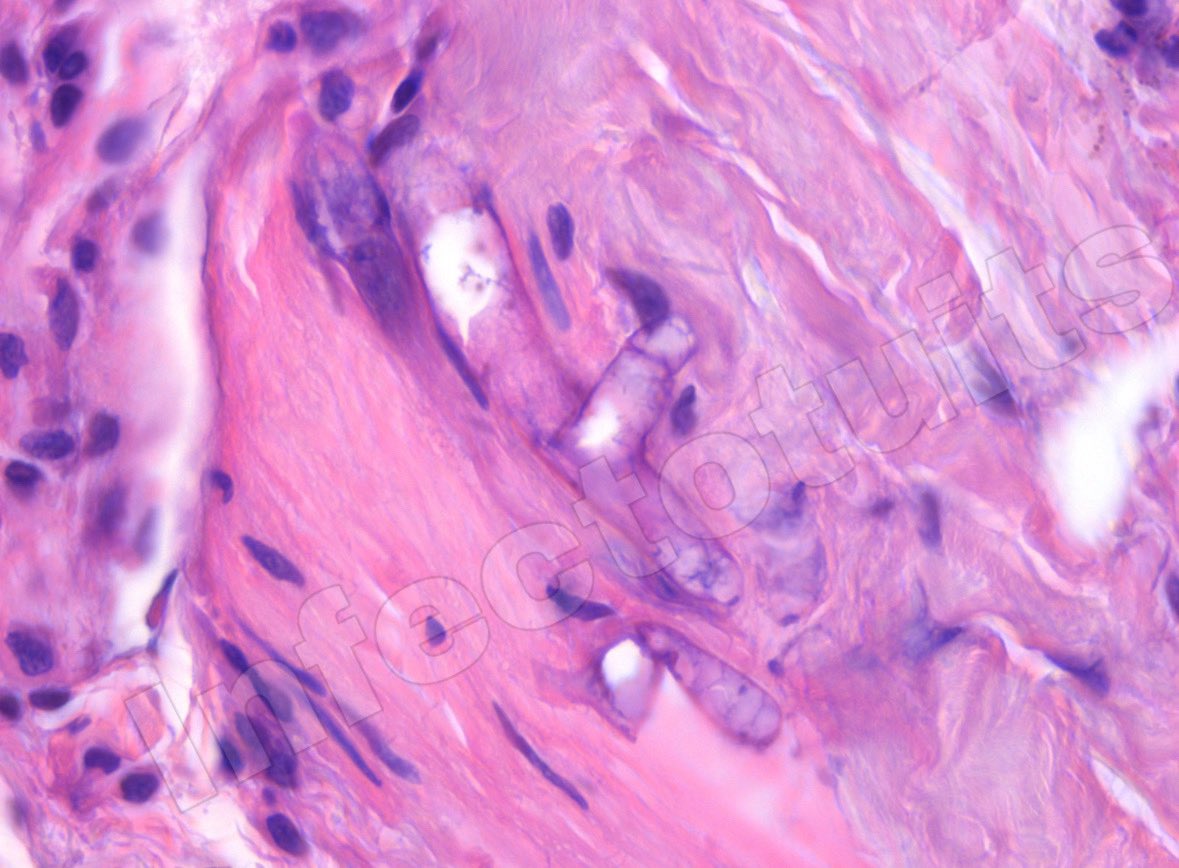infectotuits's tweet image. Hoy en #FF Fungi Friday
El diagnóstico histopatológico también es importante.
Hifa gruesa, cenocítica, y haciendo un “moño” . *mucorales*
(Biopsia de piel en un paciente trasplantado órgano sólido)
En colaboración con la Dra @ritadorantesh