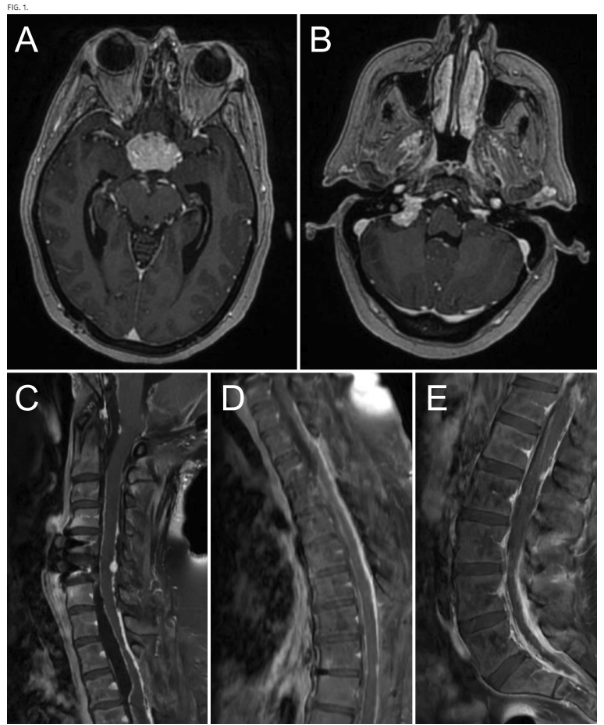 TheJNS's tweet image. #JNSCaseLessons. Researchers highlight rare case of hemangioblastoma recurrence with leptomeningeal dissemination years after initial surgical resection.
thejns.org/caselessons/vi…