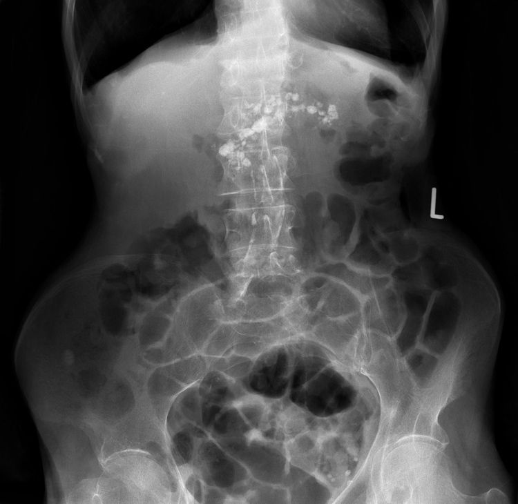 X-RAY QUIZ: What is the cause of the abnormal calcification in this image?
A: Calcified gallstones
B: Calcified mesenteric lymph nodes
C: Pancreatic calcification
D: Malignant calcification
E: Calcified uterine fibroid
Start Quiz bit.ly/3gYVY8W