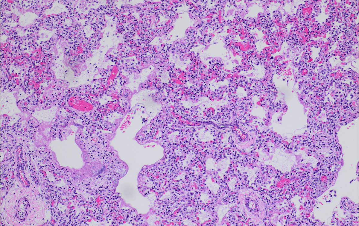 Case of the Week: A 1-month-old boy with grunting and vomiting suddenly stopped breathing. Gross autopsy was unremarkable, but lung histology led to the diagnosis. What was the source of exposure resulting in death?
 surveymonkey.com/r/DMNG5VK