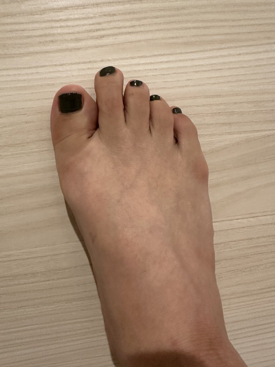 エスワンタイホウ
色素沈着経過観察14
2クール3日目

とくに副作用なし

手の先は服薬する前から黒かったから
#経口抗がん剤
#抗がん剤
#エスワンタイホウ
#色素沈着
#乳がん
#ルミナールb