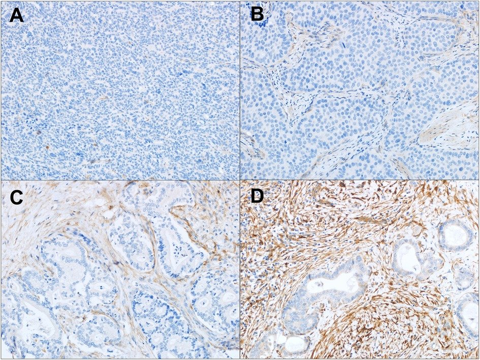 New Research: Immunohistochemical basis for FAP as a candidate theranostic target across a broad range of cholangiocarcinoma subtypes frontiersin.org/articles/10.33… #FrontiersIn #NuclearMedicine