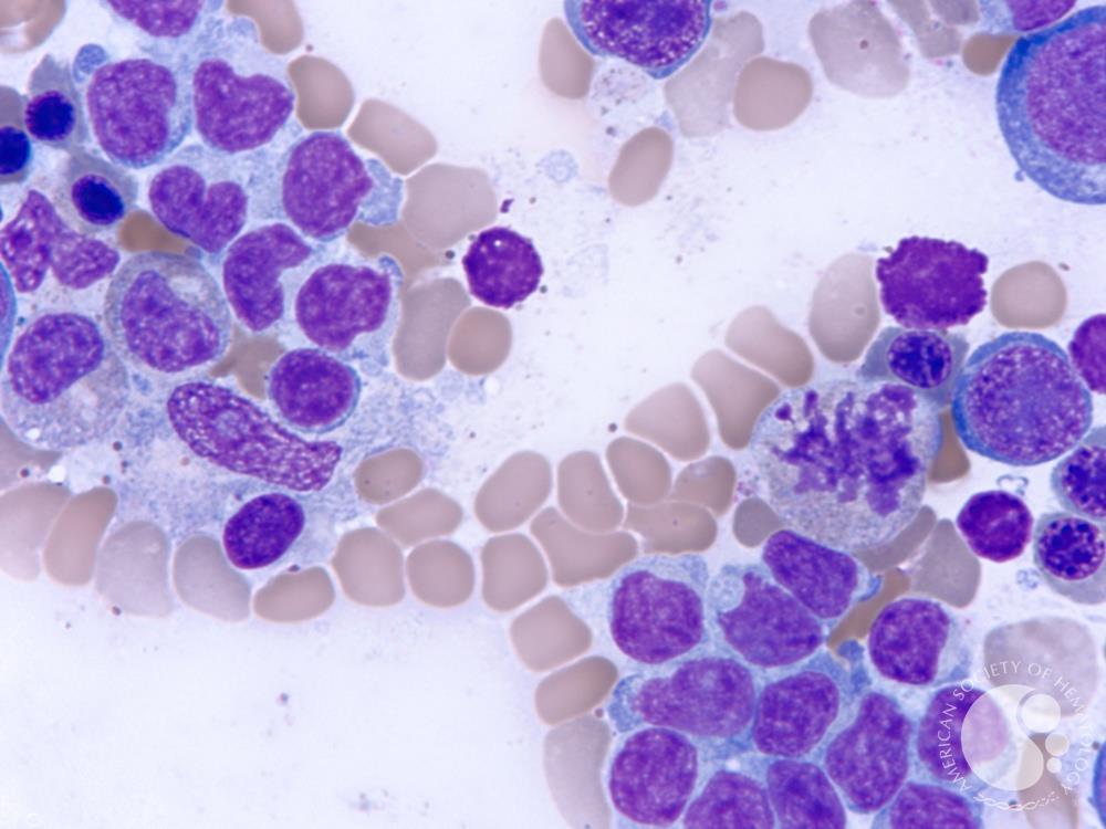 smbenlazar's tweet image. hepatosplenic T cell lymphoma | ASH Image Bank | American Society of Hematology imagebank.hematology.org/image/61461/he… #ASHImageBank