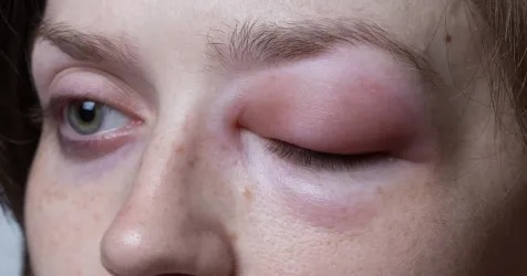 The #FDA has approved #garadacimab-gxii for prophylactic use in patients aged 12 years and older with #hereditary #angioedema, according to a press release from CSL Behring. healio.com/news/allergy-a…