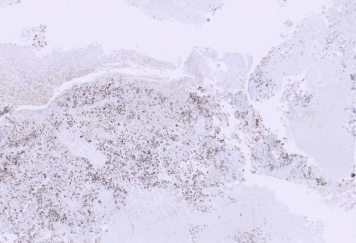 Met Ca with chondroid differentiation —&gt;metaplastic carcinoma! TRPS1 shown #pathx #pathtwitter #neuropath #neuropathology #cnspathology