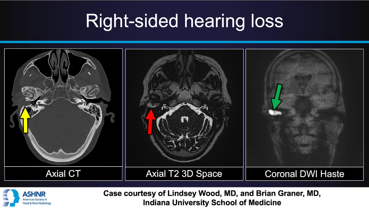 ASHNRSociety's tweet image. #ASHNRCOTW #304: Hearing loss. Thx Dr. Wood + @BDGraner 4 case! #ASHNR25
@callyrobs @DShatzkes @CDP_Rad @rhwiggins
@nakoontz @KRileyMD @CMGlastonbury @tabby_kennedy @PhilipRChapman1 @cmtomblinson
@amyfjuliano @bpoliceni @MohitTCCNeuro @AshokSrini15 @KatieTraylorDO…