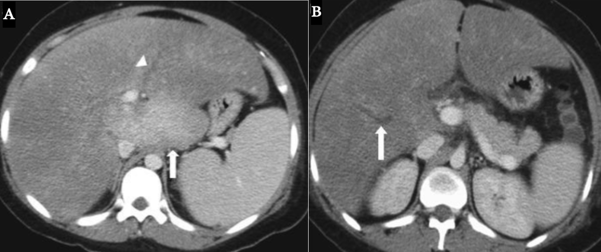 MedBlendPub's tweet image. 🧠 #CaseOfTheDay - Budd–Chiari syndrome
🔎 Constellation of findings on CT:
🔹 Diffuse peripheral hypoenhancement
🔹 Relatively hypertrophied caudate lobe with spared enhancement (A)
🔹 Thrombus in the hepatic vein (↓ attenuation) (B)
#radres #MedX