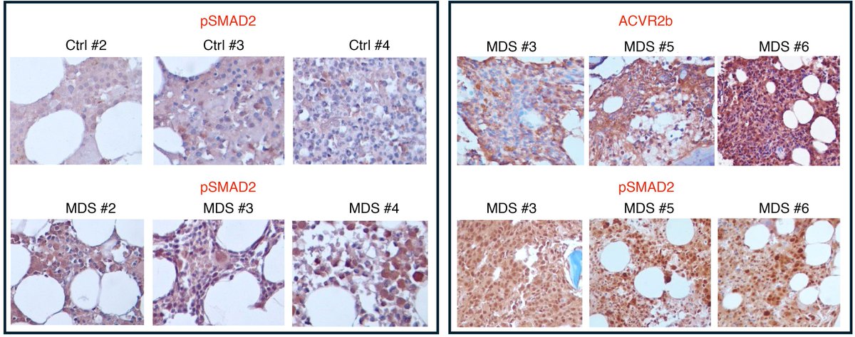 the_asci's tweet image. How does luspatercept relieve anemia in myelodysplastic syndromes?
ASCI member @Amitvermamds & team @EinsteinMed discover splicing of erythroid transcription factor is associated with therapeutic response in MDS: jci.org/articles/view/…