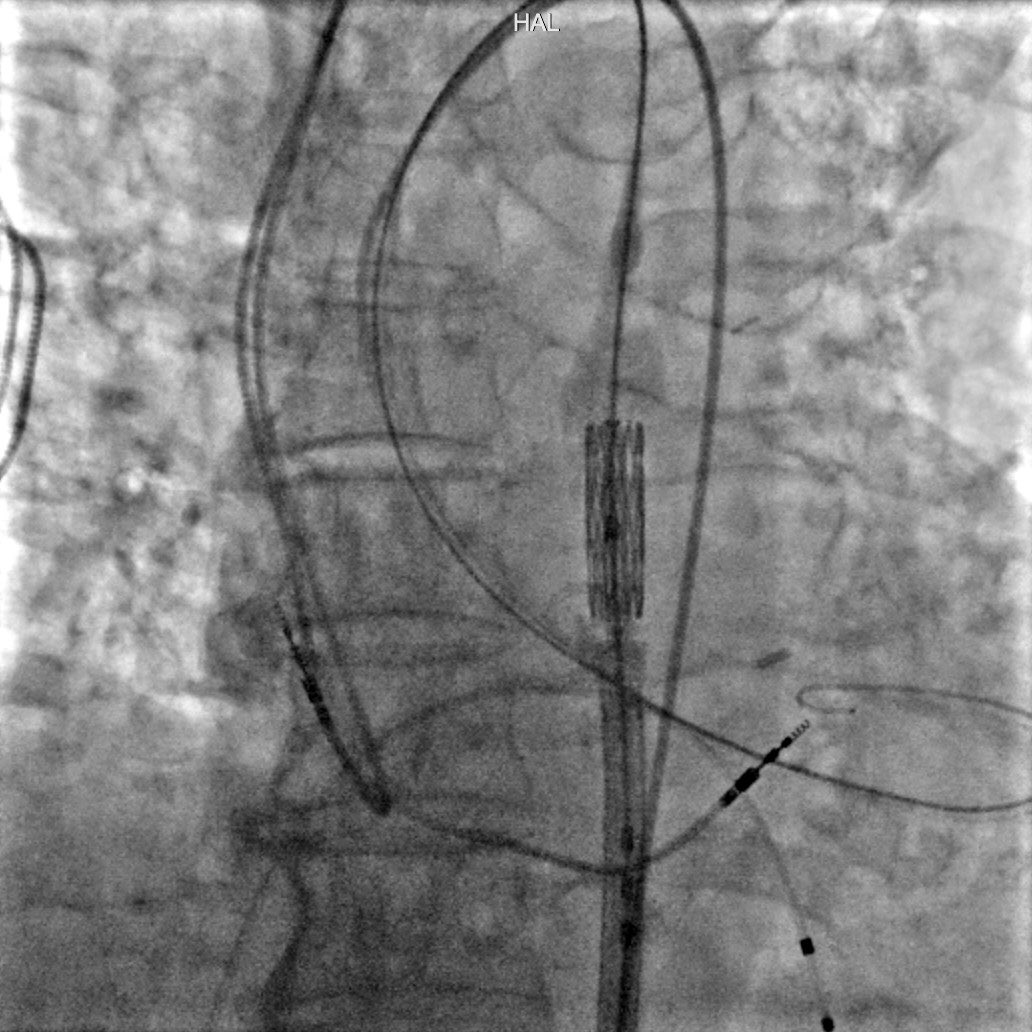 #TAVR Bumper Technique

This visual shows how this technique works. 

Without bumper, the leading edge of the THV stent can catch a lip of calcium. 

With bumper, the 🎈bulges over the leading edge and protects it from catching calcium. Also prevents scraping in aorta.