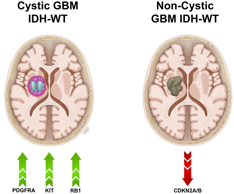 JNeurooncol's tweet image. Torres et al. analyzed 176 IDH-WT GBM tumors to identify gene mutations associated with cystic GBMs. #JNO
link.springer.com/article/10.100…