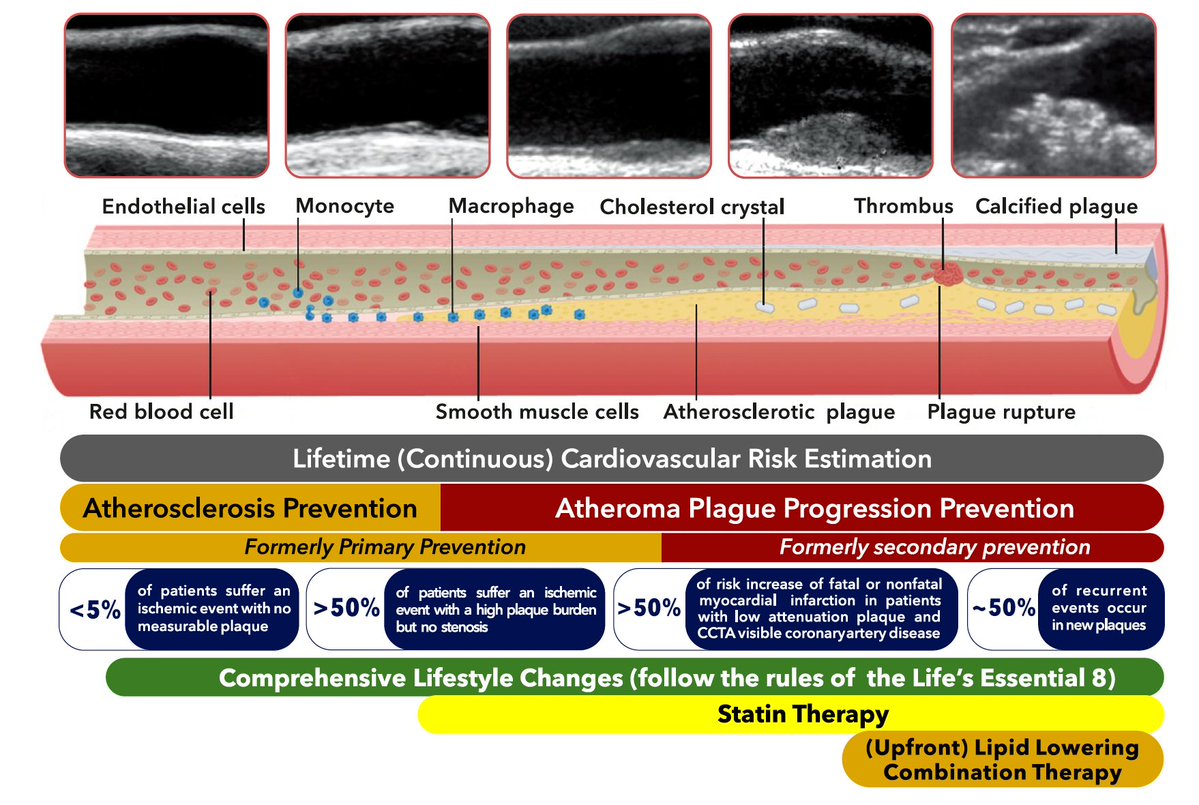 ESTRATIFICACIÓN DE RIESGO Y MANEJO SEGÚN ESTADÍO DE ATEROSCLEROSIS

-Cuándo vemos la placa calcificada en un estudio de imagen ya llegamos demasiado tarde🙄

-50% tiene eventos isquémicos sin placa, o con placa pero sin estenosis 😖

academic.oup.com/cardiovascres/…