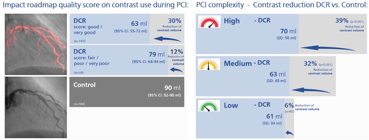 MyJSCAI's tweet image. 📖#DCR4Contrast trial: Dynamic #Coronary Roadmap in #PCI led to reduced contrast use compared to conventional #angiography, with better roadmap scores linked to the lowest contrast volume 💡#ReducedContrast
➡️doi.org/10.1016/j.jsca…
@HennesseyBreda @JEscaned @DrJMessenger…