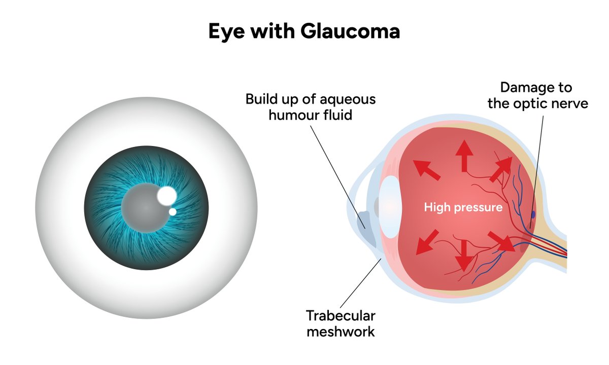 PNASNexus's tweet image. Using CRISPR to knock out two genes that are associated with the production of aqueous humor can reduce intraocular pressure in mice, potentially making it a useful once-a-month therapy for glaucoma patients—and a replacement for daily drops. Read more: ow.ly/PU4750Wopvn