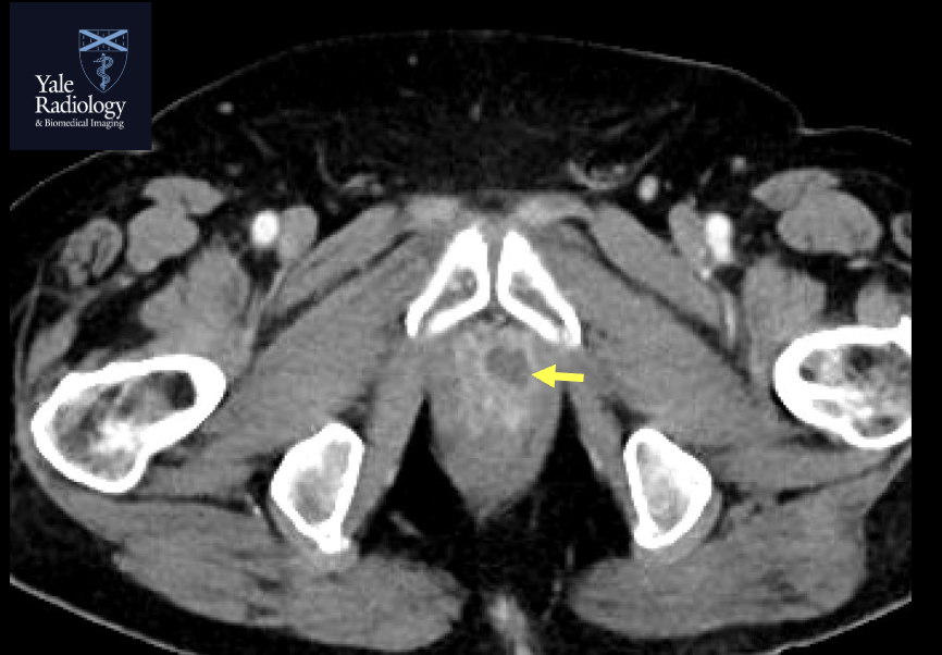 Mahan_Mathur's tweet image. #MEDSTUDENTMONDAYS: fever + WBC with urinary tract infection; patient had rim-enhancing prostate collection which turned out to be an abscess.#yaleradedu #yaleradiology #MedStudentMondays #FOAMrad #FOAMed #radres
@RadDiscord #MedTwitter @YaleRadRes @Yale_IR