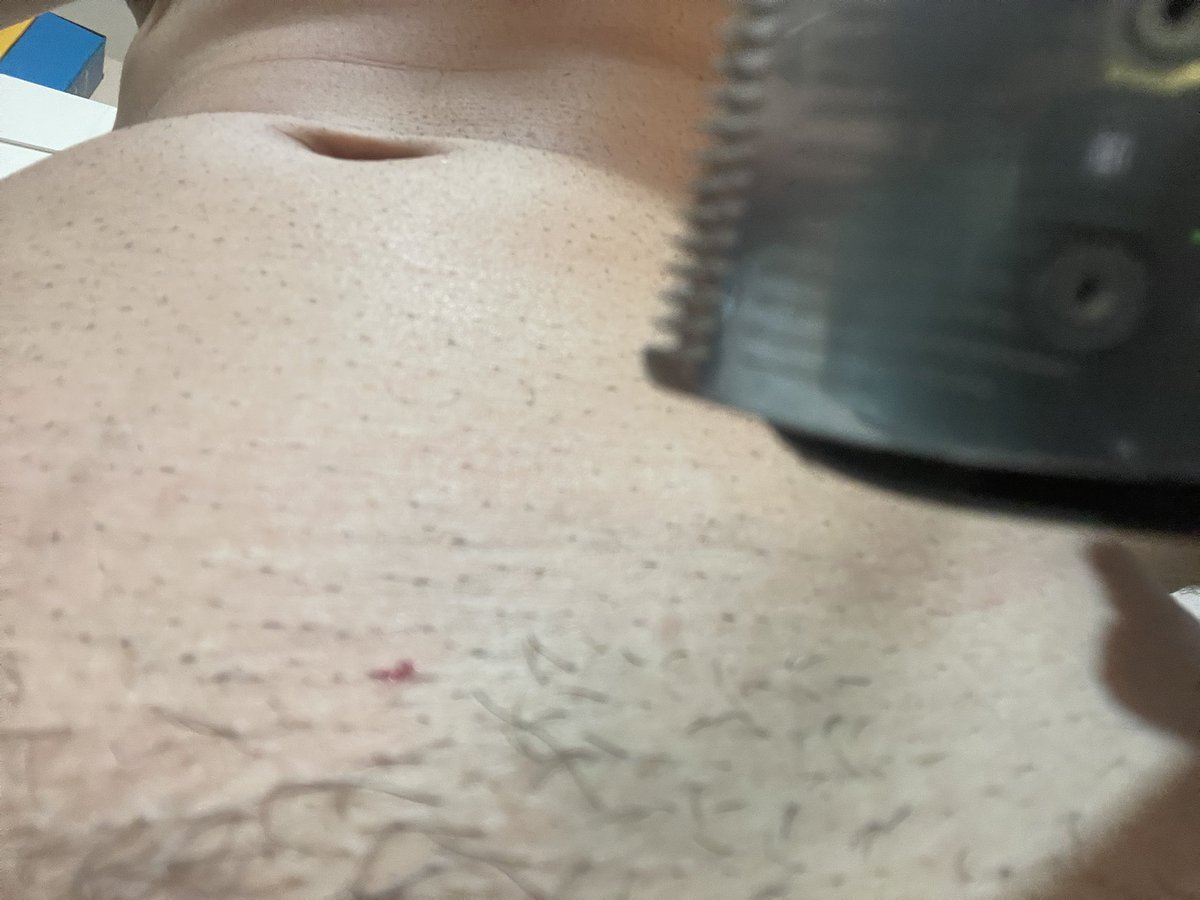 GaboAliendres's tweet photo. @Philips Can I sue them for every cut on my body? I have marks from past cuts, even on my chest, and I know other people with this condition who use this brand of razors! We can file a class-action lawsuit. I invite you to write to me! https://t.co/Hw2rd1j9k5