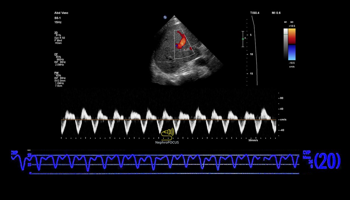 #VExUS classic! (HV Doppler- CVP waveform comparison) 
#POCUS #FOAMed #Nephpearls