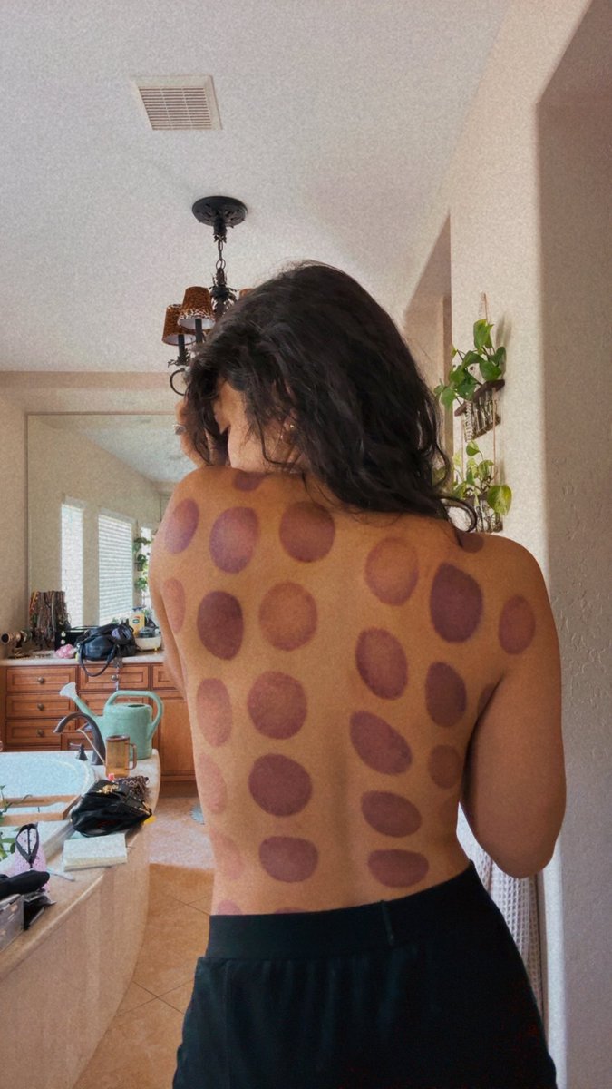 So does cupping work or no? Everyone is 50/50 in my comments! I really hope it works. My back is too sore to tell right now