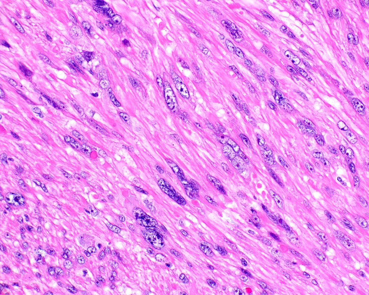 ModernPathology's tweet image. Back to some basics.  Leiomyosarcomas are amongst the sarcoma types that spread to lymph nodes, a phenomenon that is interesting to see.