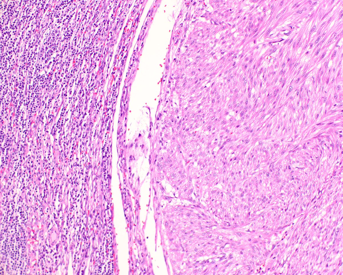 ModernPathology's tweet image. Back to some basics.  Leiomyosarcomas are amongst the sarcoma types that spread to lymph nodes, a phenomenon that is interesting to see.