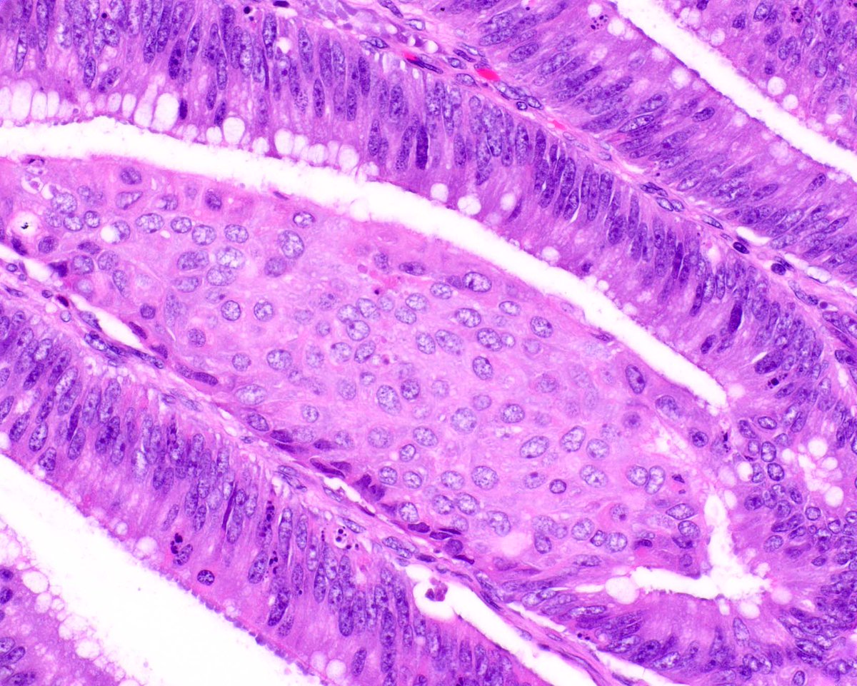 Innovative Science Press (@science_press) on Twitter photo This colon adenoma shows "pseudoinvasion", and squamous morules, which are generally incidental findings.  Some term them "micro-carcinoids" based on patchy expression of neuroendocrine markers. This colon adenoma shows "pseudoinvasion", and squamous morules, which are generally incidental findings.  Some term them "micro-carcinoids" based on patchy expression of neuroendocrine markers.